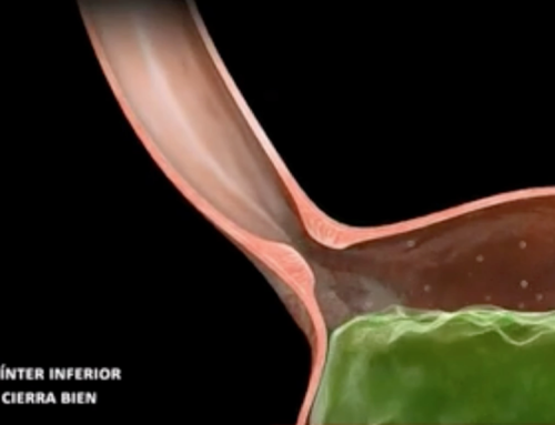 ¿Porqué tengo reflujo y como puedo tratarlo?